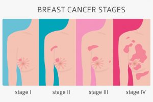 Jenis Makanan Penyebab Kanker Payudara Yang Wajib Diketahui Jenis Makanan Penyebab Kanker Payudara Yang Wajib Diketahui